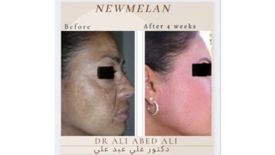 صورة توضيحية - newmelan pigmentation الحل الأنسب لمعالجة تصبّغات الوجه مدى الحياة حديث مع دكتور التجميل ali abedali