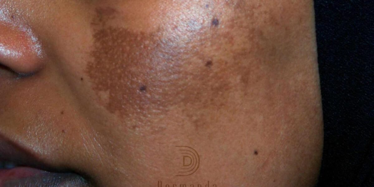 Dermanda Clinic إسم رائد في علاج الكلف بمختلف أنواعه - صورة مميزة Dermanda Clinic إسم رائد في علاج الكلف بمختلف أنواعه
