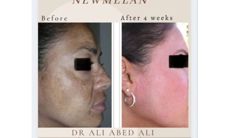 newmelan pigmentation الحل الأنسب لمعالجة تصبّغات الوجه مدى الحياة حديث مع دكتور التجميل ali abedali