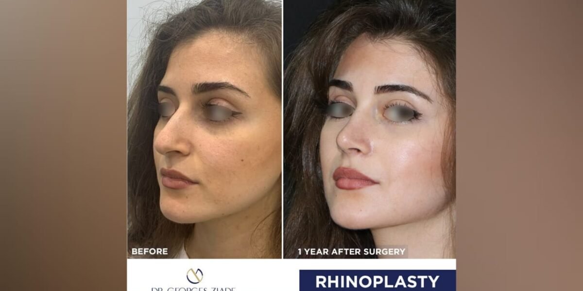 جورج زيادة في حديث حول عمليات تجميل الأنف/Rhinoplasty
