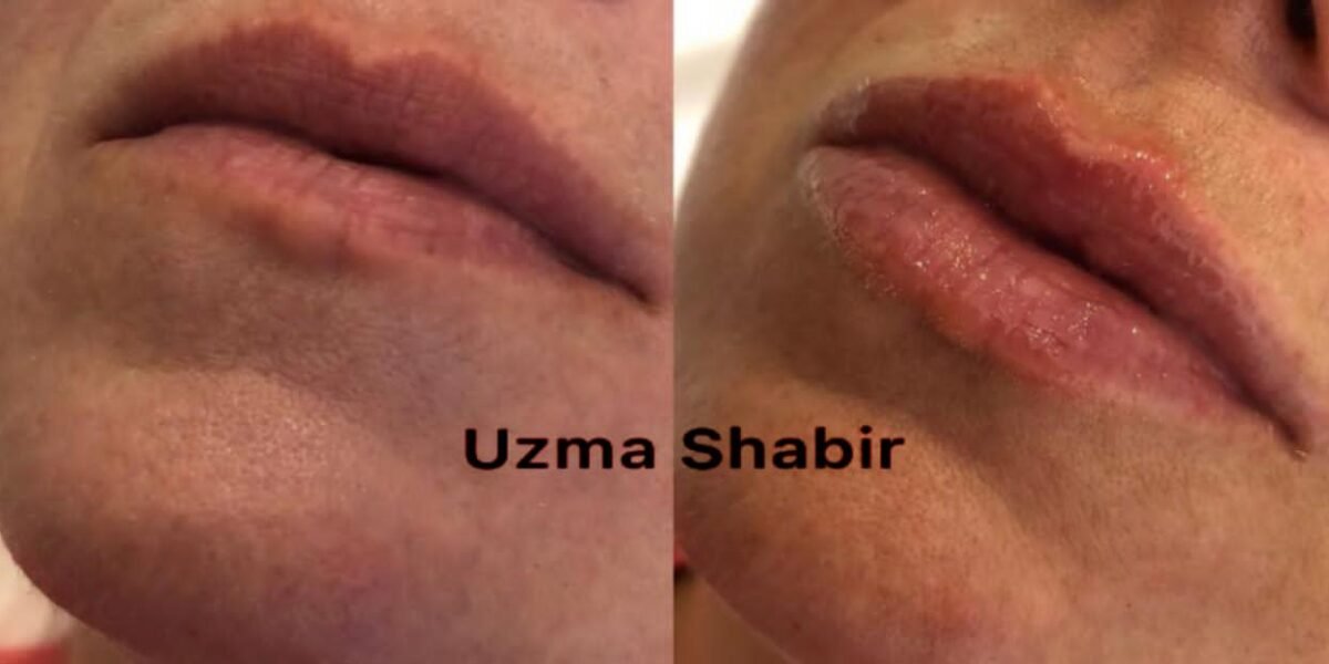 خبيرة التجميل عظمي شبير/ Uzma Shbr خبيرة في مجال حقن الفيلر - صورة مميزة صورة مميزة: خبيرة التجميل عظمي شبير/ Uzma Shbr خبيرة في مجال حقن الفيلر